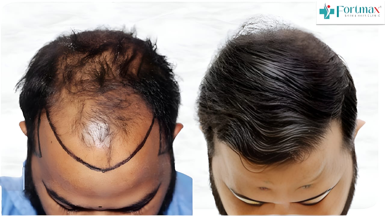 Corrective-hair-transplant